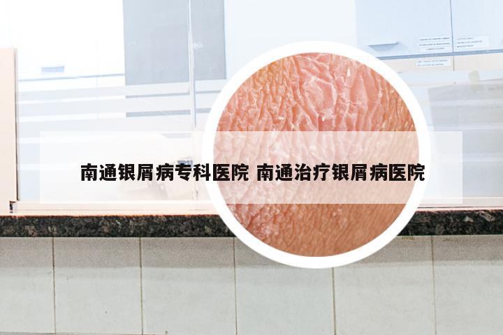 南通银屑病专科医院 南通治疗银屑病医院