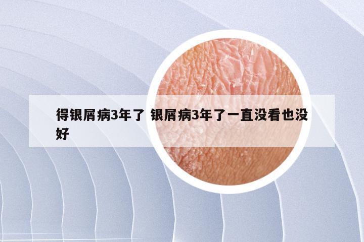得银屑病3年了 银屑病3年了一直没看也没好