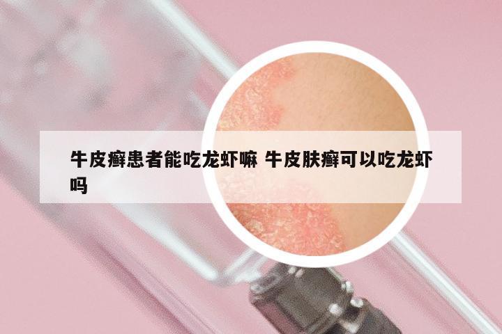 牛皮癣患者能吃龙虾嘛 牛皮肤癣可以吃龙虾吗