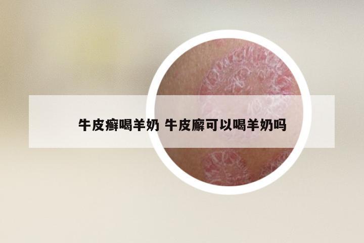 牛皮癣喝羊奶 牛皮廨可以喝羊奶吗