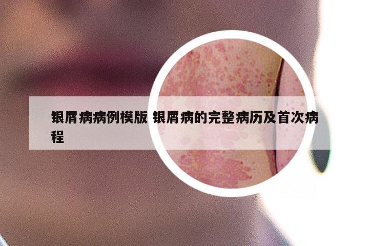 银屑病病例模版 银屑病的完整病历及首次病程