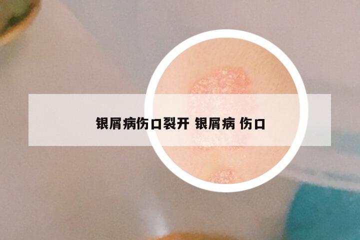 银屑病伤口裂开 银屑病 伤口