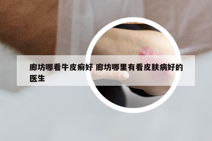 廊坊哪看牛皮癣好 廊坊哪里有看皮肤病好的医生