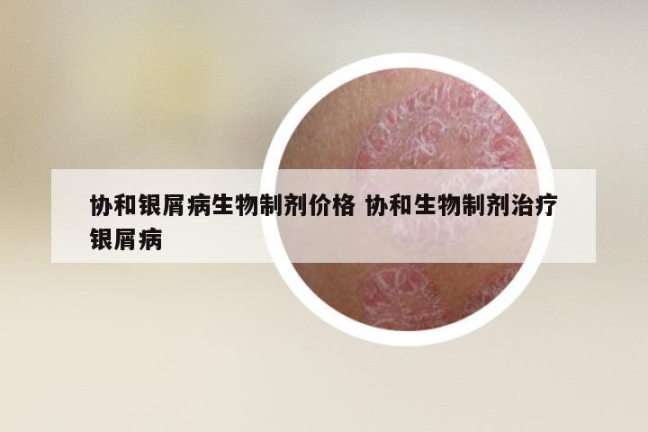 协和银屑病生物制剂价格 协和生物制剂治疗银屑病