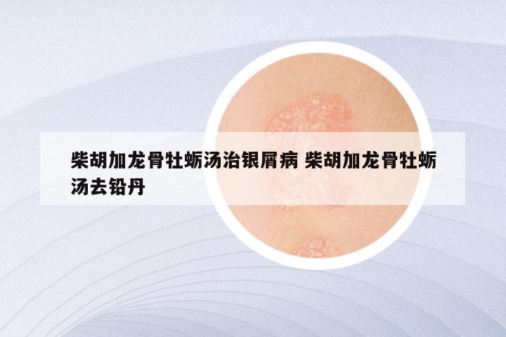 柴胡加龙骨牡蛎汤治银屑病 柴胡加龙骨牡蛎汤去铅丹