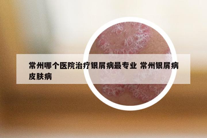 常州哪个医院治疗银屑病最专业 常州银屑病皮肤病