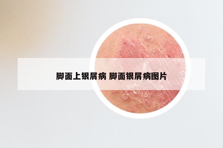 脚面上银屑病 脚面银屑病图片