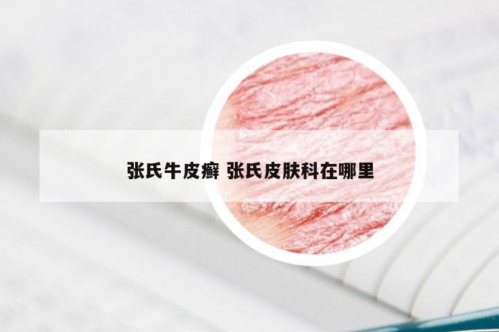 张氏牛皮癣 张氏皮肤科在哪里
