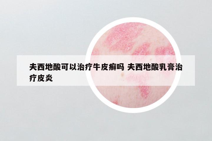 夫西地酸可以治疗牛皮癣吗 夫西地酸乳膏治疗皮炎