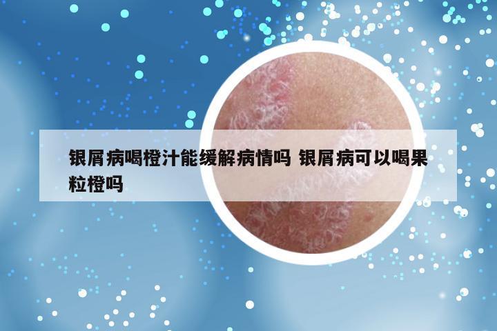 银屑病喝橙汁能缓解病情吗 银屑病可以喝果粒橙吗