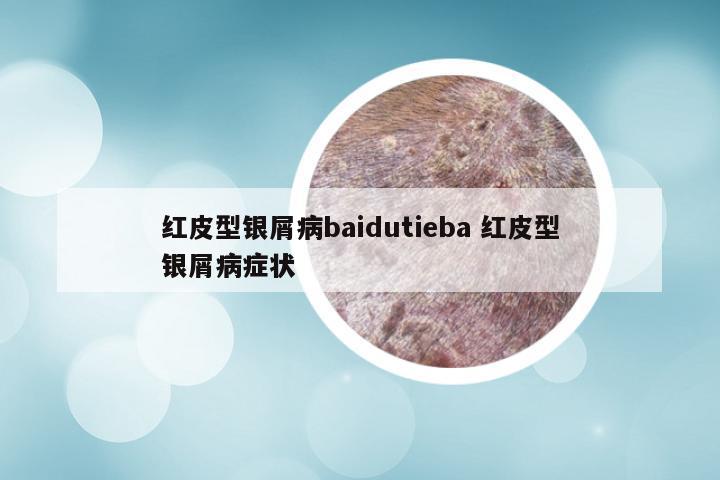红皮型银屑病baidutieba 红皮型银屑病症状