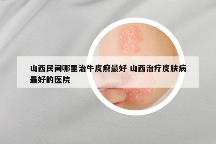山西民间哪里治牛皮癣最好 山西治疗皮肤病最好的医院