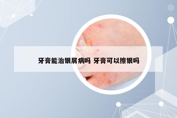 牙膏能治银屑病吗 牙膏可以擦银吗