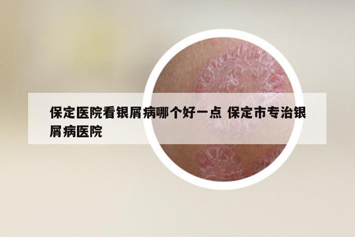 保定医院看银屑病哪个好一点 保定市专治银屑病医院