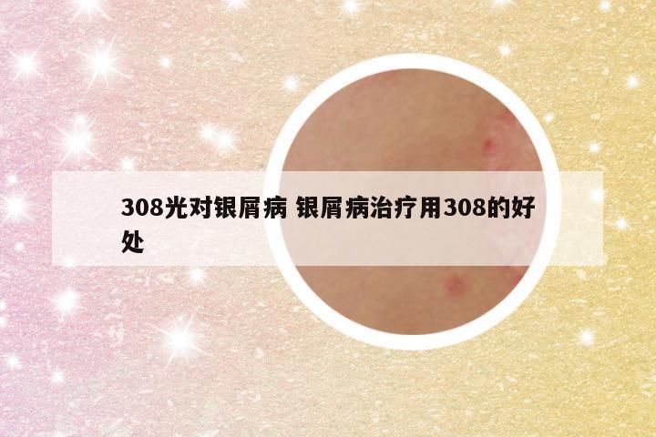308光对银屑病 银屑病治疗用308的好处