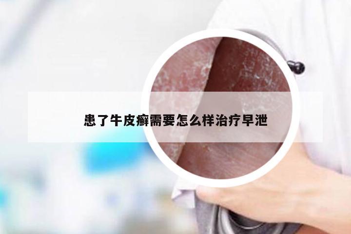 患了牛皮癣需要怎么样治疗早泄