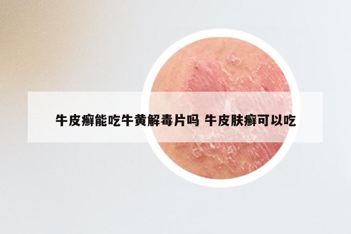 牛皮癣能吃牛黄解毒片吗 牛皮肤癣可以吃