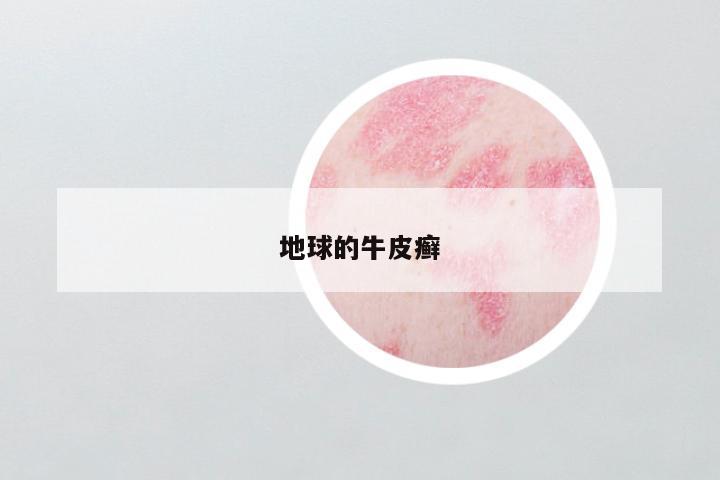 地球的牛皮癣