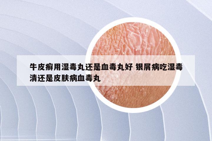 牛皮癣用湿毒丸还是血毒丸好 银屑病吃湿毒清还是皮肤病血毒丸