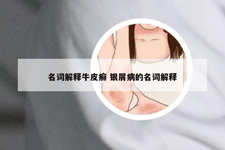 名词解释牛皮癣 银屑病的名词解释