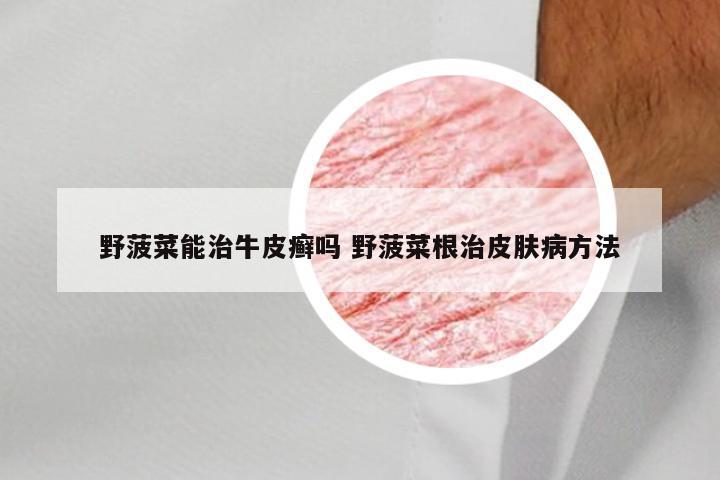 野菠菜能治牛皮癣吗 野菠菜根治皮肤病方法