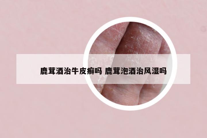 鹿茸酒治牛皮癣吗 鹿茸泡酒治风湿吗