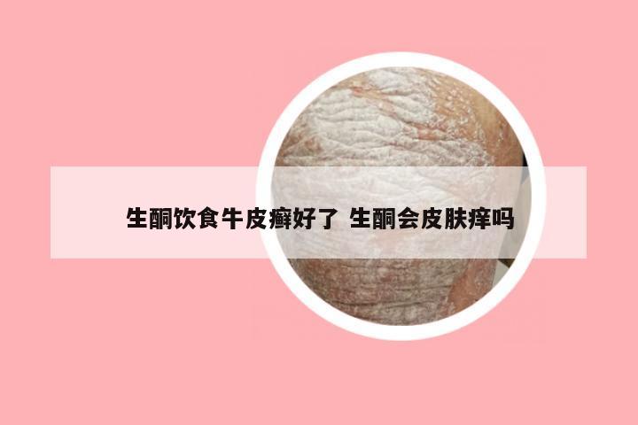 生酮饮食牛皮癣好了 生酮会皮肤痒吗