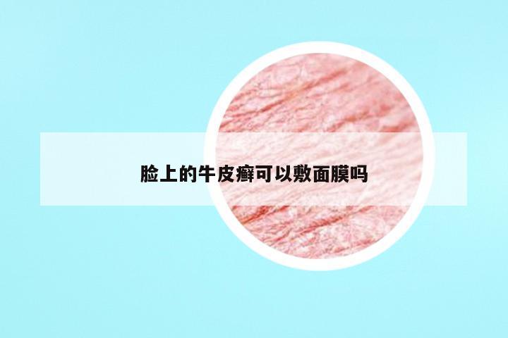 脸上的牛皮癣可以敷面膜吗