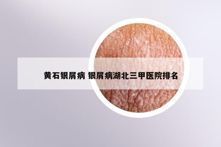 黄石银屑病 银屑病湖北三甲医院排名