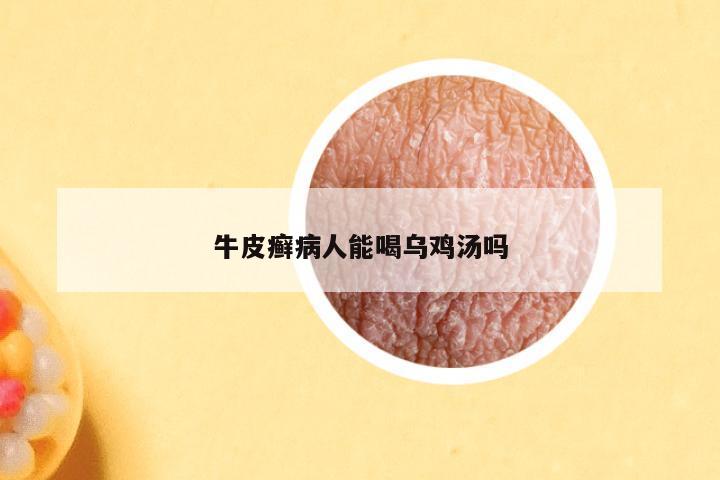 牛皮癣病人能喝乌鸡汤吗
