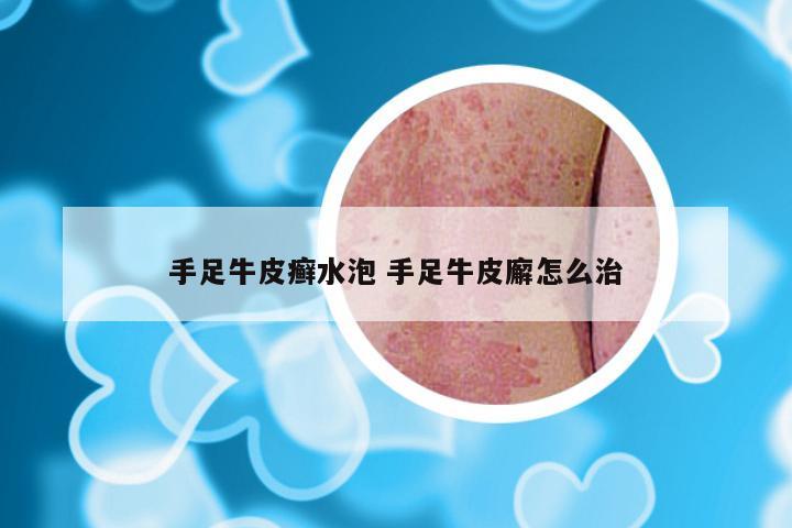 手足牛皮癣水泡 手足牛皮廨怎么治