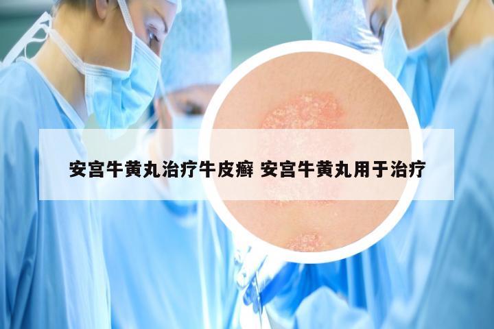 安宫牛黄丸治疗牛皮癣 安宫牛黄丸用于治疗
