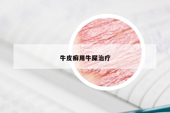 牛皮癣用牛屎治疗