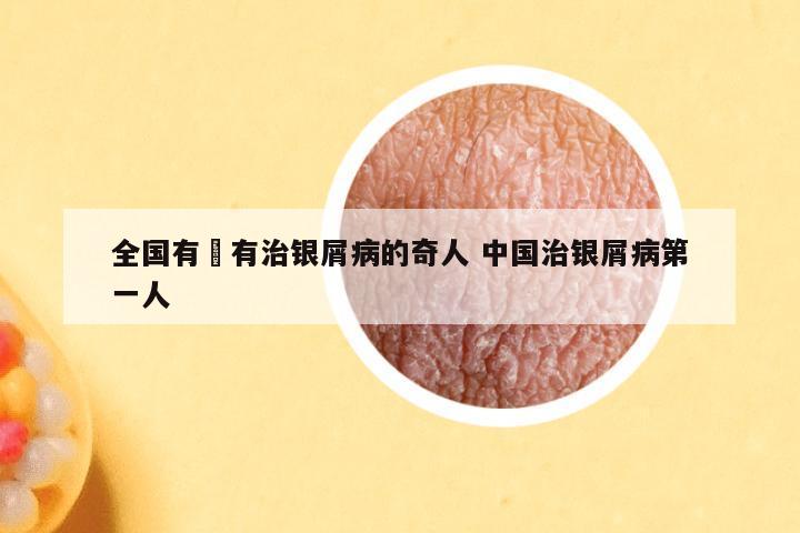 全国有沒有治银屑病的奇人 中国治银屑病第一人