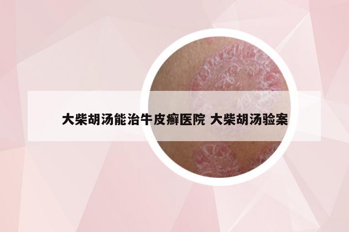 大柴胡汤能治牛皮癣医院 大柴胡汤验案
