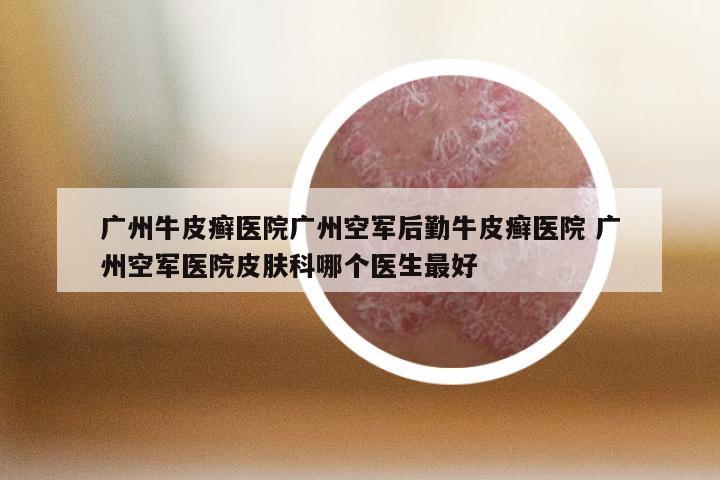 广州牛皮癣医院广州空军后勤牛皮癣医院 广州空军医院皮肤科哪个医生最好