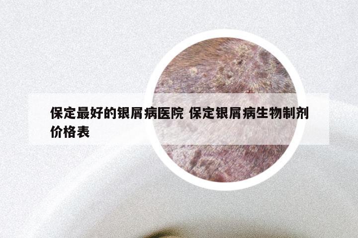 保定最好的银屑病医院 保定银屑病生物制剂价格表