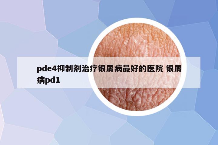 pde4抑制剂治疗银屑病最好的医院 银屑病pd1