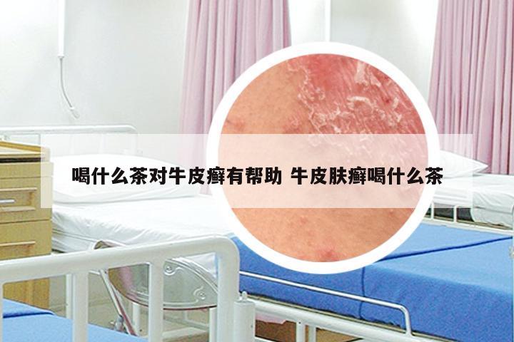 喝什么茶对牛皮癣有帮助 牛皮肤癣喝什么茶