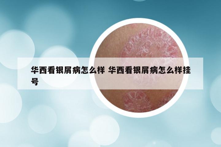 华西看银屑病怎么样 华西看银屑病怎么样挂号