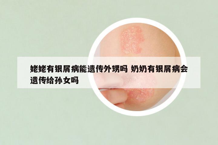 姥姥有银屑病能遗传外甥吗 奶奶有银屑病会遗传给孙女吗