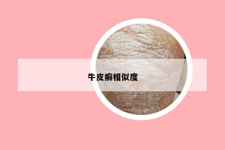牛皮癣相似度
