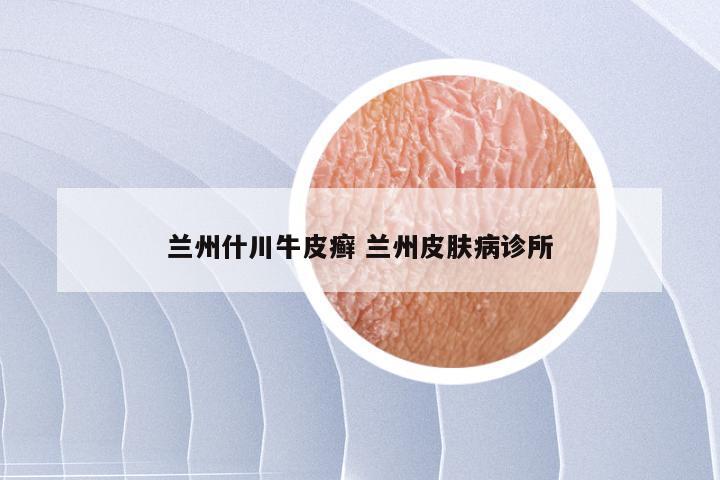 兰州什川牛皮癣 兰州皮肤病诊所