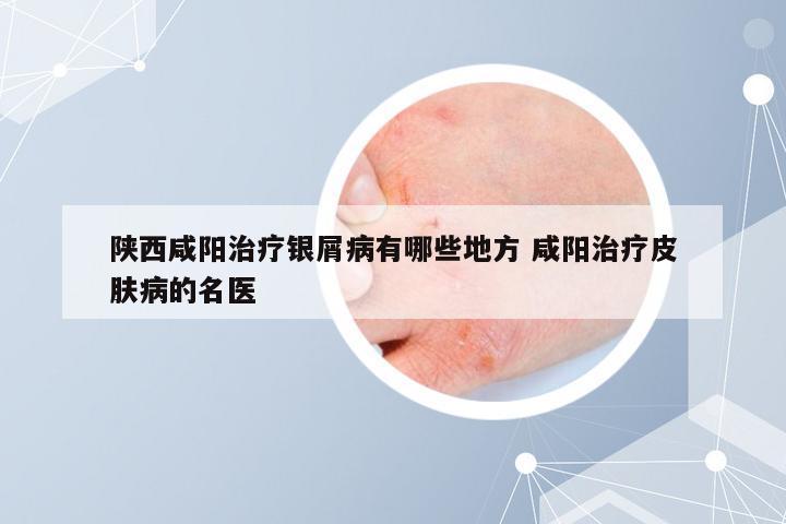 陕西咸阳治疗银屑病有哪些地方 咸阳治疗皮肤病的名医