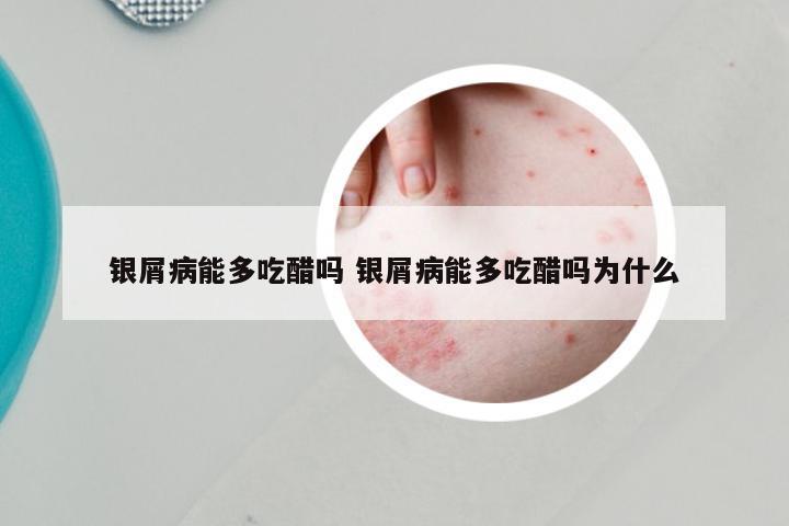 银屑病能多吃醋吗 银屑病能多吃醋吗为什么