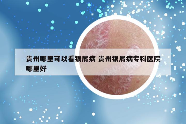 贵州哪里可以看银屑病 贵州银屑病专科医院哪里好