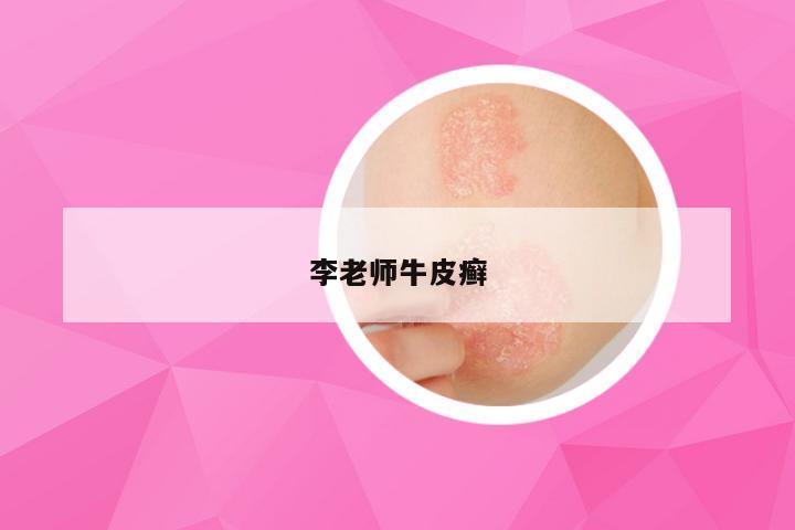 李老师牛皮癣