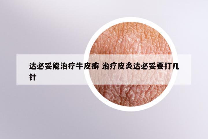 达必妥能治疗牛皮癣 治疗皮炎达必妥要打几针