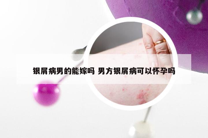 银屑病男的能嫁吗 男方银屑病可以怀孕吗