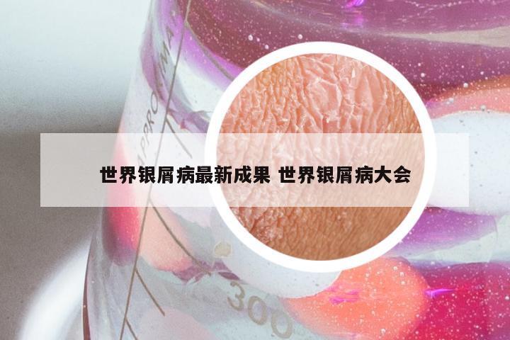 世界银屑病最新成果 世界银屑病大会